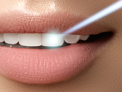 Granger Dentistry | Night Guards, ZOOM  Whitening and Sedation Dentistry
